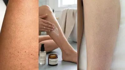 Strawberry Legs Explained: Causes, Care Tips And Easy Remedies For Smoother Skin