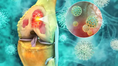 Sarcoma: All you need to know