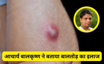बालतोड़ का इलाज जल्दी कैसे करें? Acharyaˈ Balkrishna ने बताया कैसे ठीक होंगे ये फोड़ेˌ