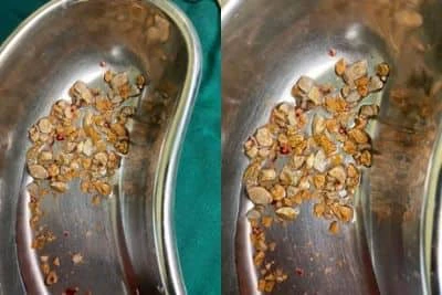 206 Kidney Stones Removed From 56-Year-Old Hyderabad Man In 1-Hour Surgery