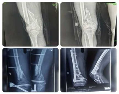 Advanced orthopedic surgery restores mobility of accident victim at GBP Hospital Agartala