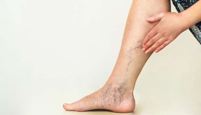 Home Remedies For Varicose Veins