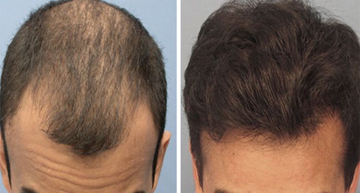 गंजे सिर पर फिर से बाल उगाने के बेहतर घरेलू उपाय - Kalyan Ayurved |  DailyHunt