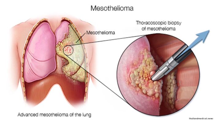 treatment for stage 4 mesothelioma