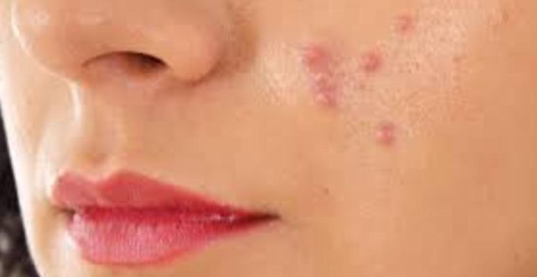 अगर चेहरे के पिंपल्स और दाग धब्बे नहीं हट रहे ,तो ये करें अगर चेहरे के पिंपल्स और दाग धब्बे नहीं हट रहे ,तो ये करें