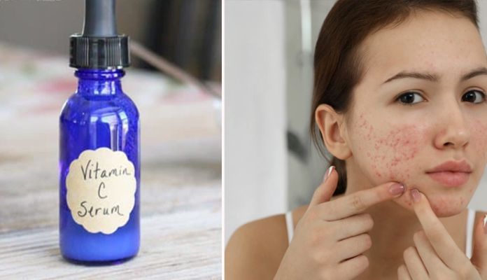 serum to heal acne scars