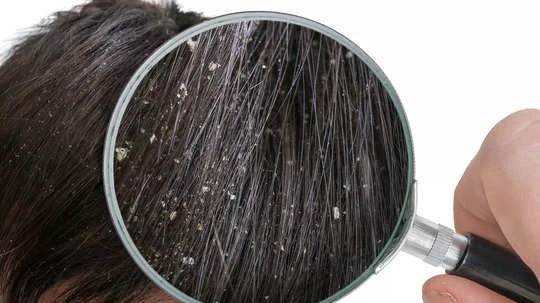 Dandruff: Know the causes and methods of prevention