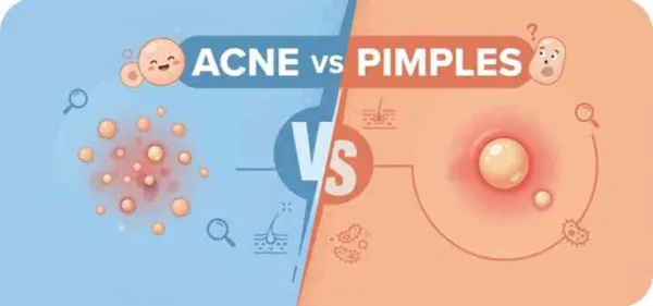 Acne vs Pimples: Understanding the Key Differences for Better Skin Care