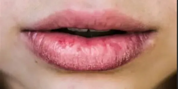 लाल, जामुनी, सफेद या काले होंठ? ये रंग दे रहे हैं बीमारी का इशारा