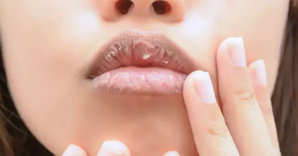 വരണ്ട ചുണ്ടുകള്ക്ക് പരിഹാരം; ഇക്കാര്യങ്ങള് ശ്രദ്ധിക്കൂ