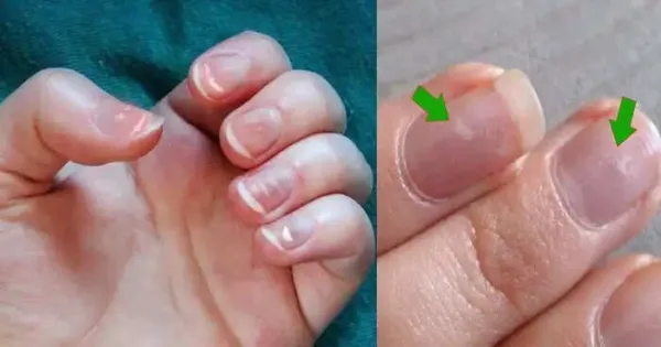Understanding Nail Marks: Insights from Palmistry