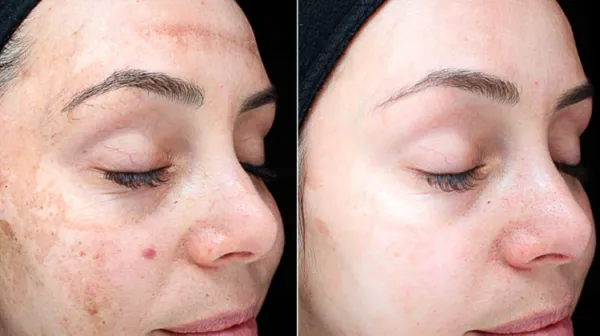 ମୁହଁକୁ ଅସୁନ୍ଦର କରୁଛି କଳାଦାଗ