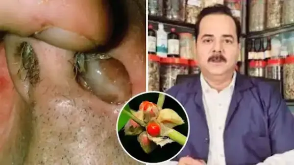 नाक -(nose) का मांस बढ़ गया, कम आ रही सांस? "Dr. इरफान ने बताया देसी नुस्खा, "15 दिन में ठीक हो जाएगी बढ़ी हुई हड्डी'