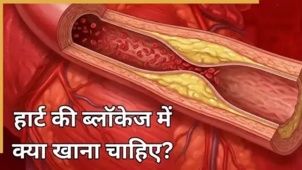 हार्टब्लॉकेज का सबसे अच्छा इलाज क्या है? जानिए Heart Blockage खोलने के लिए क्या खाना चाहिए