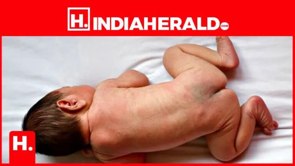 Does Your Baby Have This Birthmark? Millions of Babies Are Born With This Blue Birthmark