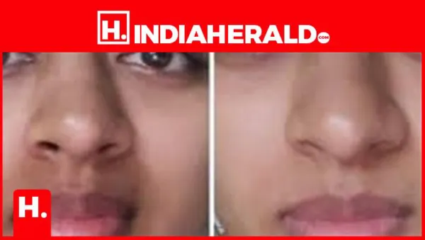 4 DIY Ways to Treat Pigmentation Around Lips