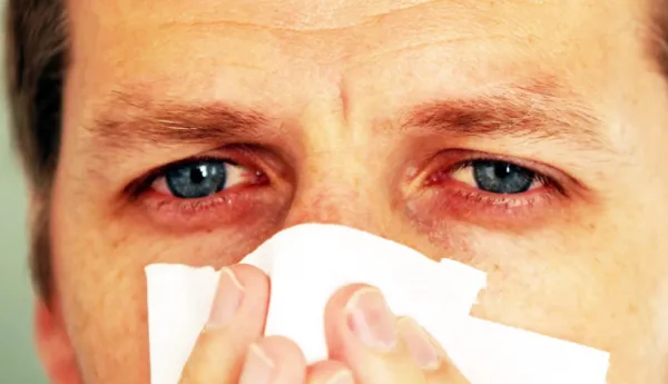 Top Home Remedies To Treat Red Eyes