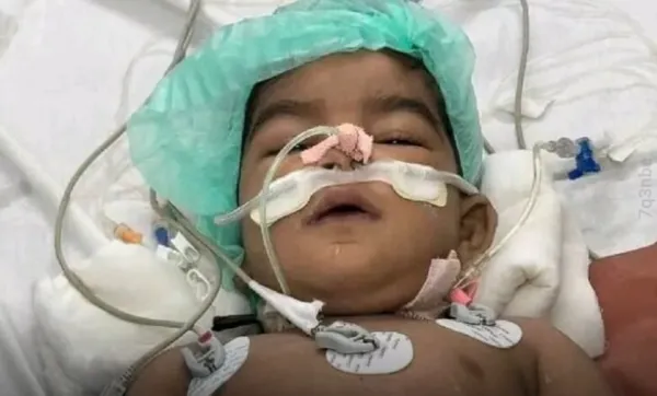 عٹمانیہ کے ڈاکٹروں کا حیران کن کارنامہ - 14 گھنٹہ کی طویل سرجری کے بعد 18 ماہ کے بچہ کی جان بچالی