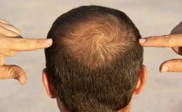 बस 1 महीने तक सरसों के तेल में ये एक चीज` "मिलाकर लगाए गंजे सिर में उगने लगेंगे नए बाल लोग कहने लगेंगे जुल्फी जुल्फी''