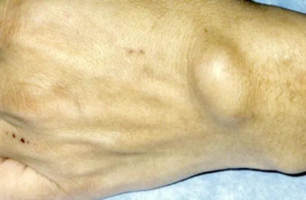 କେଉଁ ଭିଟାମିନ୍‌ ଅଭାବରୁ ଶରୀରରେ ଦେଖାଦିଏ  ଗଣ୍ଠି ସମସ୍ୟା.ଜାଣନ୍ତୁ