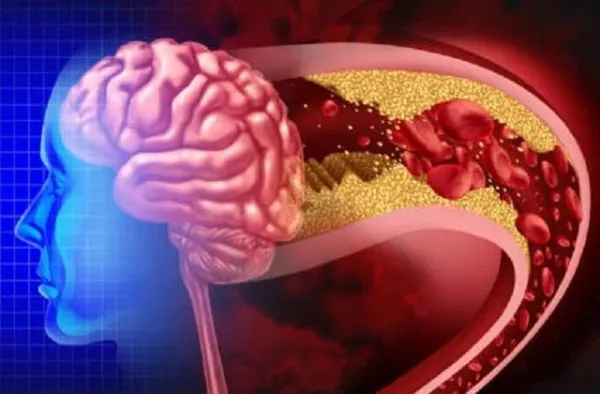 ​​​​​​Brain' सही से काम नहीं कर रहा अगर दिखें ये लक्षण तो तुरंत करवाएं चेकअप