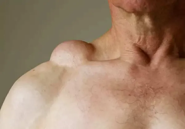 Health tips: Fat lumps in the body. If you do this, they will dissolve like butter!!