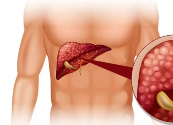 Liver Disease Symptoms: Are your palms red too? The doctor warns that it could be a sign of liver disease.