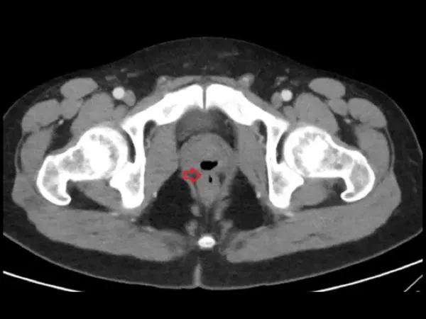 ಫಿಸ್ತುಲಾ ತಂದಿಟ್ಟಿದೆ ತೀವ್ರ ಫಜೀತಿ..!