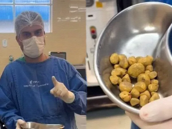 Shocking Kidney Disaster: 35 Stones from Coca Cola