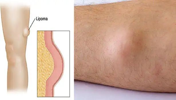 शरीर में बनी हुई चर्बी की गांठ. यह करें तो मक्खन की तरह घुल जाएगी ...