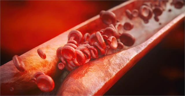 इवोल्यूक्यूमैब दवा से पहले हार्ट अटैक को रोकना अब संभव