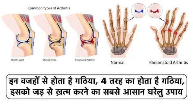 इन वजहों से होता है गठिया, 4 तरह का होता है गठिया., इसको जड़ से ख़त्म करने का सबसे आसान घरेलु Tips ...