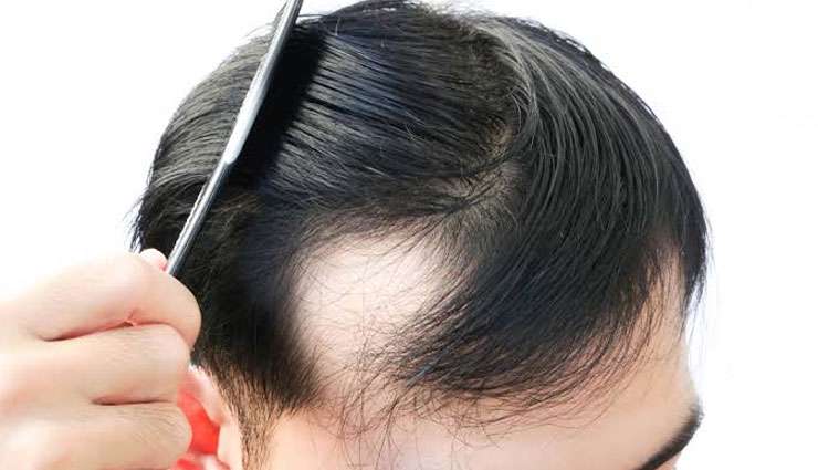 5 Natural Ways To Treat Hair Baldness Lifeberrys English