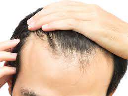 Why Men Lose Their Hairs At Early Age Know The Real Cause Tezz