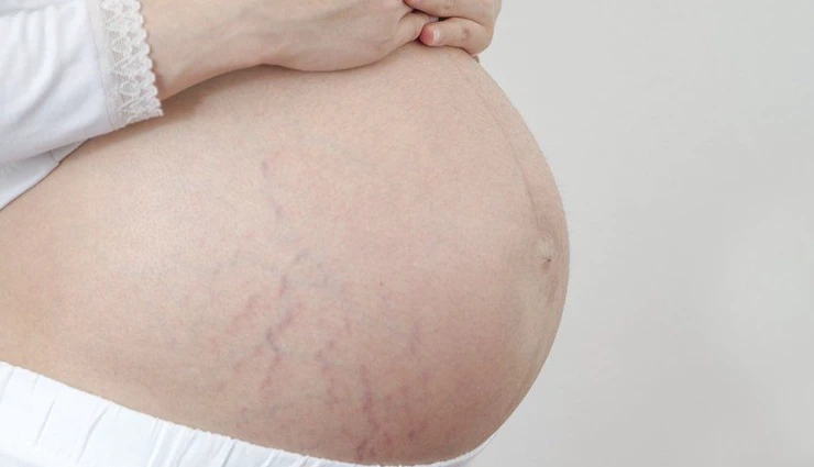 7 Best Ways To Avoid Stretch Marks During Pregnancy