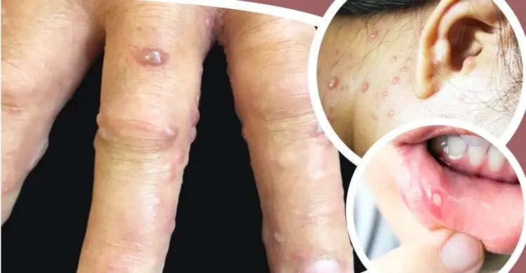 क्या एक बार चिकनपॉक्स होने के बाद दोबारा नहीं होता डॉक्टरों के खुलासे ने सबको चौंकाया