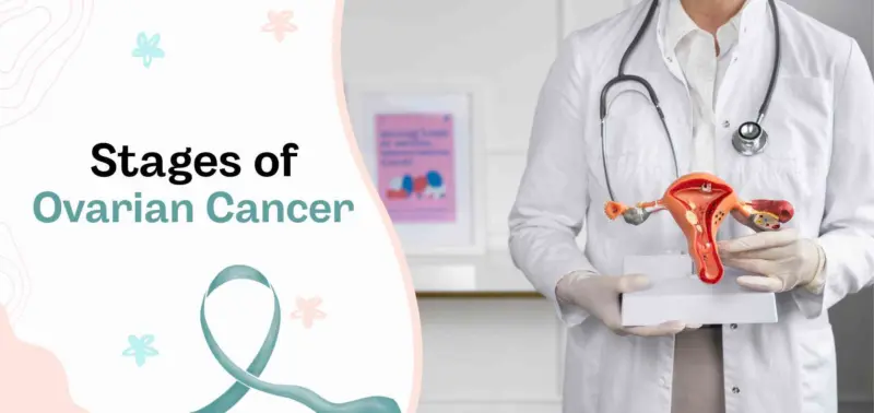 A Clear Guide to 4 Stages of Ovarian Cancer and What They Mean