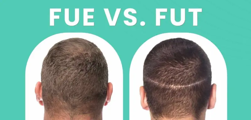 FUE vs. FUT: Which Hair Transplant Method Is Right for You?