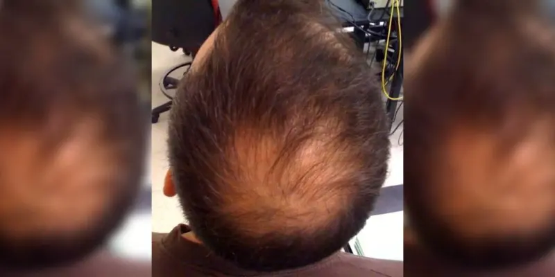 Intermittent fasting may lead to hair loss, says Chinese study