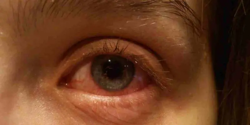 Madras eye on the rise: Doctors explain dos and don'ts