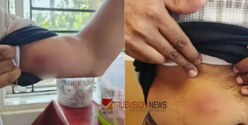 കൊയിലാണ്ടിയില്‍ മീറ്റര്‍ റീഡിങ്ങിനെത്തിയ കെഎസ്‌ഇബി ജീവനക്കാരന് നേരെ വളര്‍ത്തുനായയുടെ ആക്രമണം