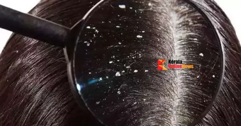 താരന്‍ കളയും ഈ നാട്ടുവൈദ്യം