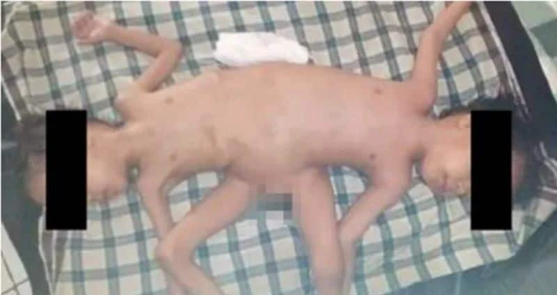 1 in 2 million case: Rare Indonesian conjoined twins, born with 4 arms & 3 legs, undergo surgical correction