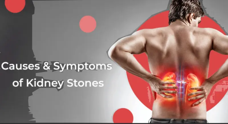 पथरी का पहला लक्षण - शुरुआत में दर्द कहां-कहां होता है, जानें