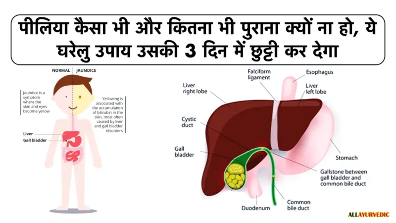 पीलिया कैसा भी और कितना भी पुराना क्यों ना हो'..ये घरेलु उपाय उसकी 3 दिन में छुट्टी' कर देगा.