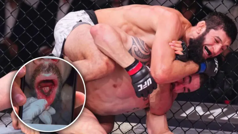 GRAPHIC image of Robert Whittaker's jaw broken down by sports doctor after UFC 308