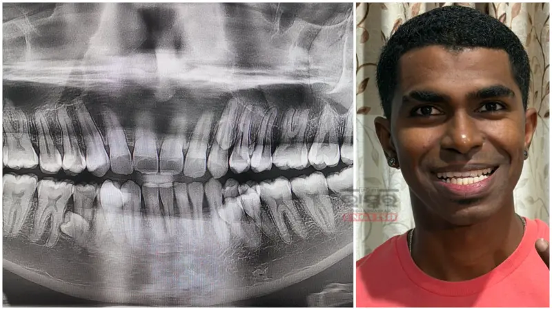 Malaysian Man Sets Guinness Record With 42 Teeth