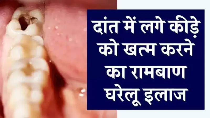 Effective Home Remedies to Treat Tooth Cavities