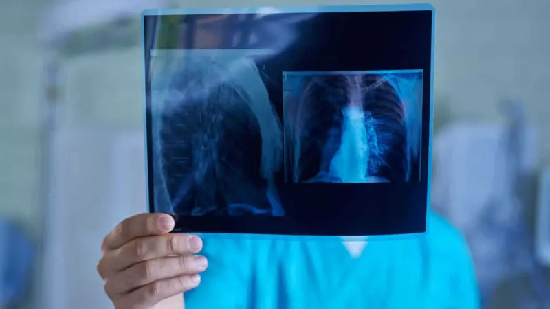 What you should know about Lung Cancer