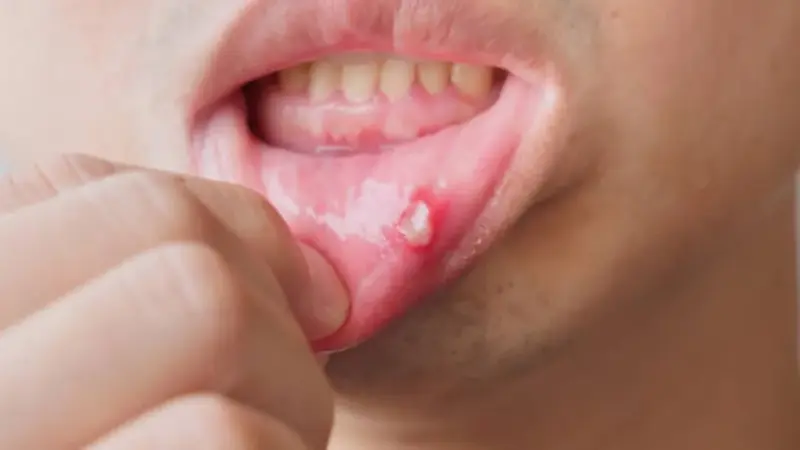 Mouth Ulcers म्हणजे काय? उष्णतेमुळे आलेले तोंड बरे करण्यासाठी करून पहा 'हे' घरगुती उपाय, तात्काळ मिळेल आराम